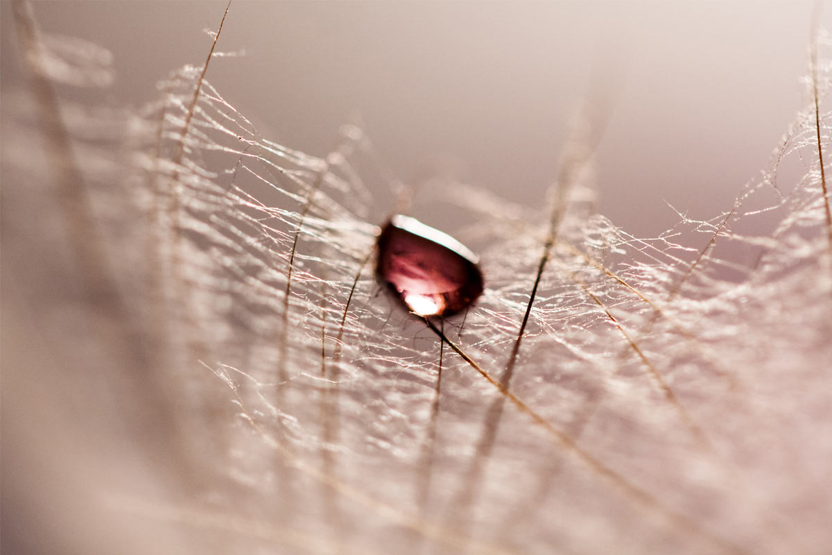 How Does Traditional Chinese Medicine View Subchorionic Bleeding?
