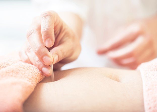 Practitioner needling a point on a woman’s abdomen performing Acupuncture for Fertility.