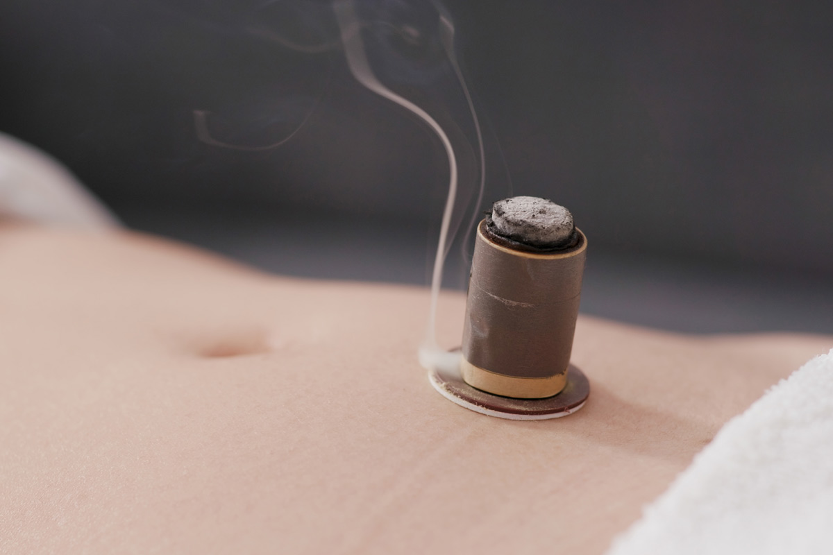 Specific Acupuncture Points and Moxibustion Techniques for Fertility