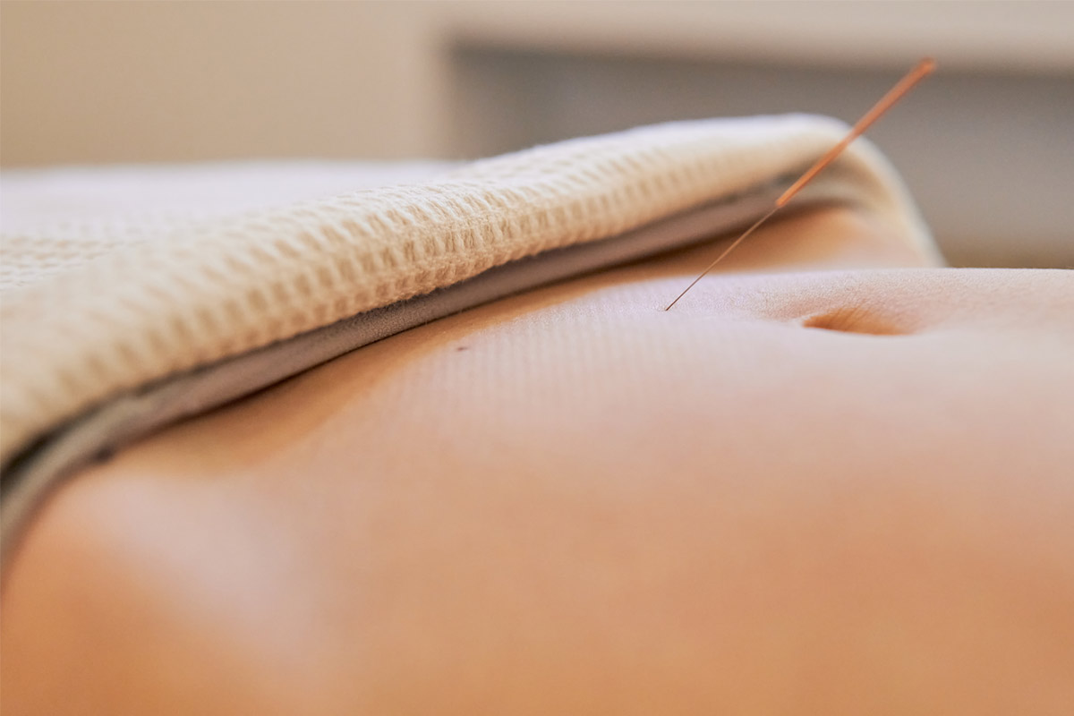 Acupuncture for Ovulation: How the Needles Help